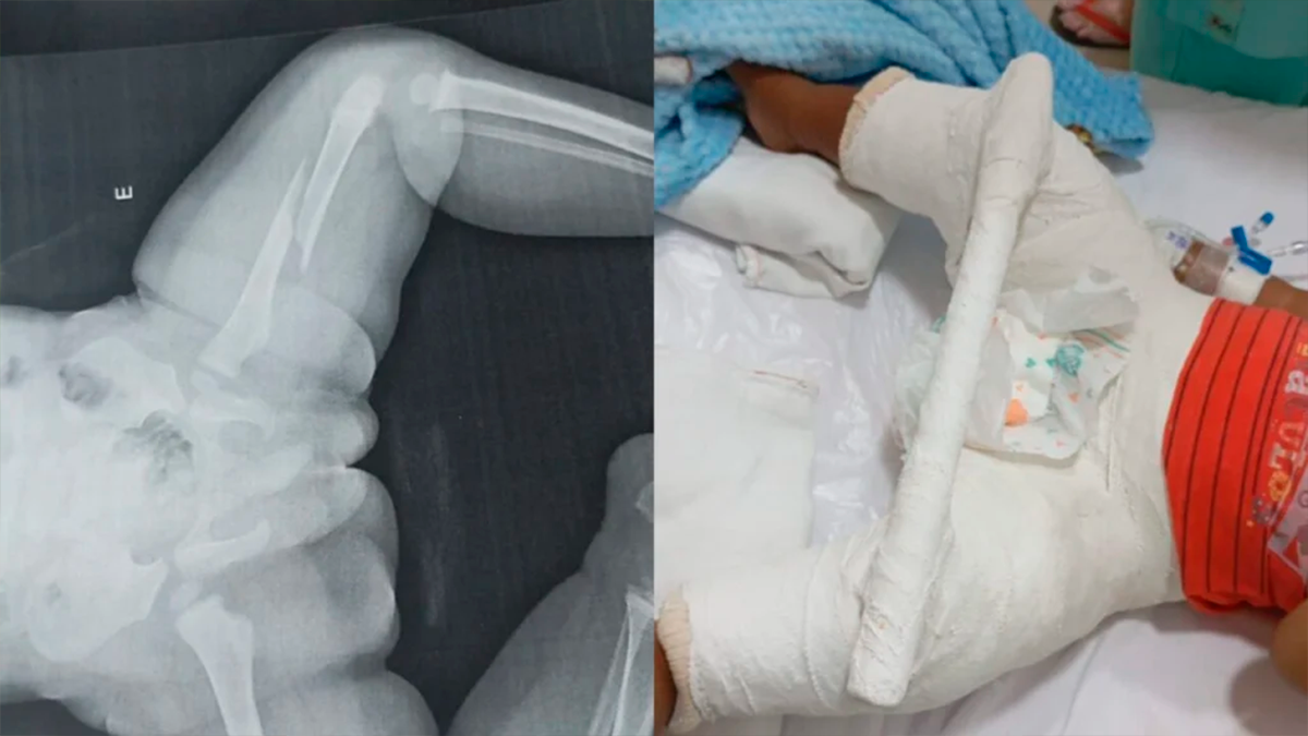 Investigação: Bebê é internado com fratura no fêmur sob suspeita de agressão em Maringá