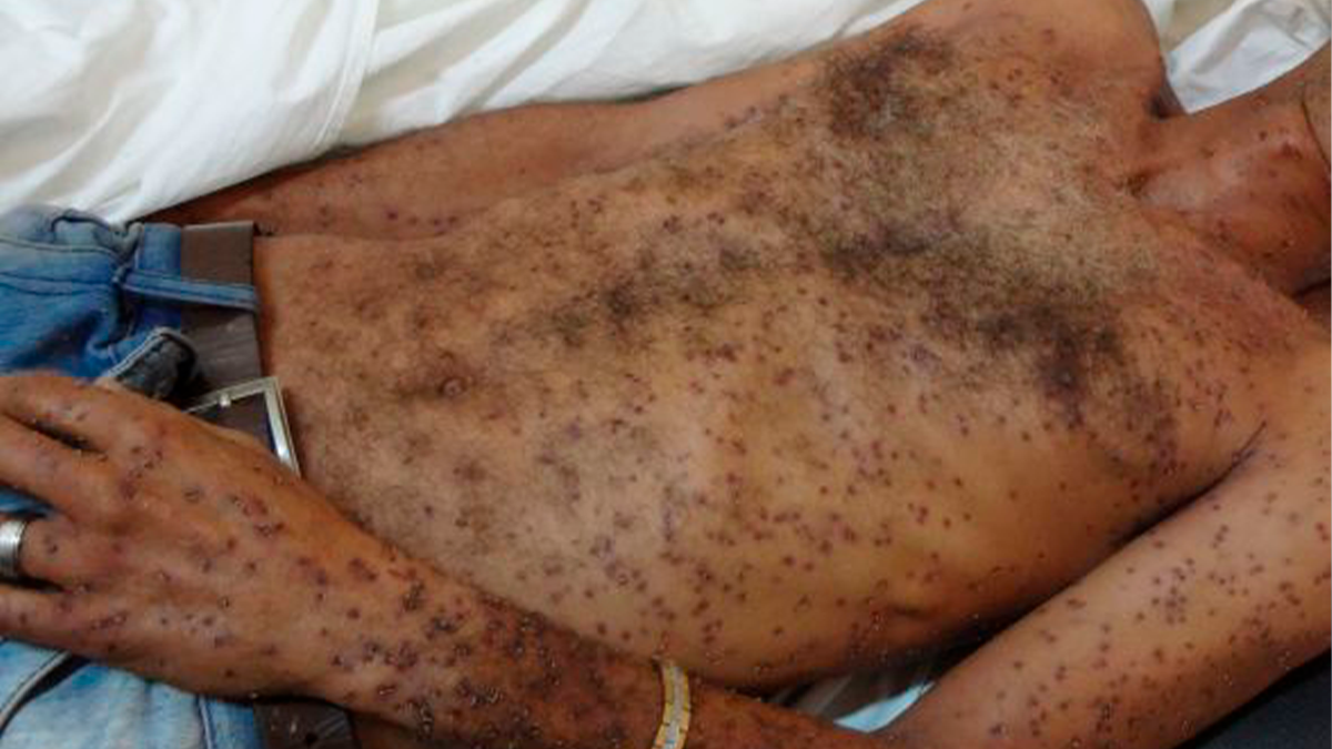 Homem sobrevive a ataque de enxame e recebe mais de 100 picadas no Oeste de Santa Catarina