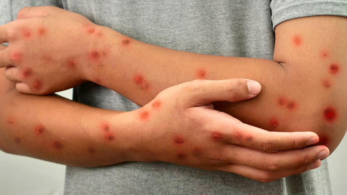 Paraná confirma primeiro caso de Mpox em 2026