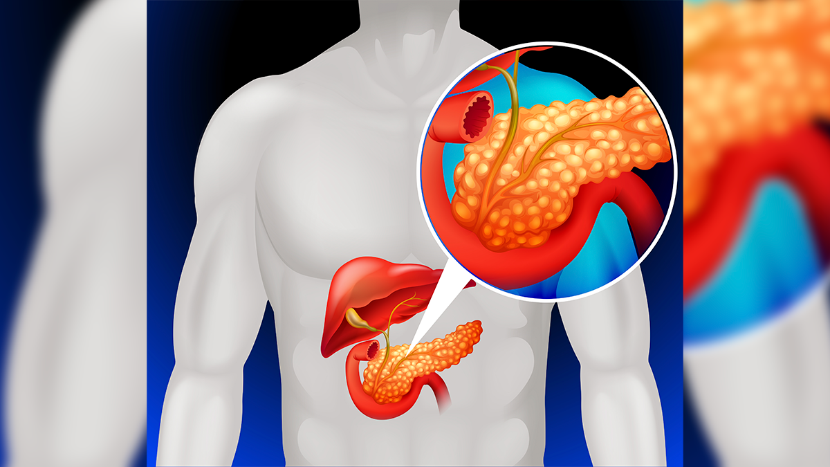 Gordura no fígado: a nova epidemia silenciosa que ameaça milhões de brasileiros